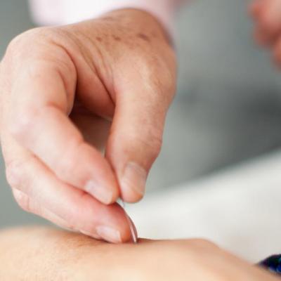 Acupuncture. Image: Acupuncture.